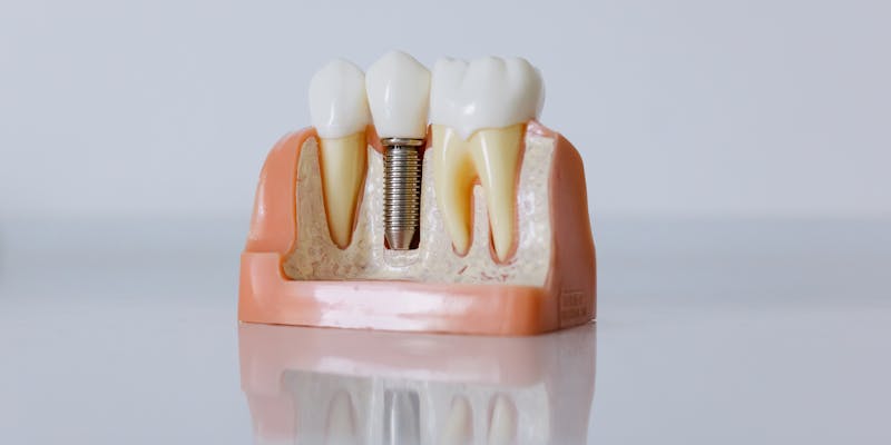 Como encontrar um especialista em implantes dentários em Campinas?